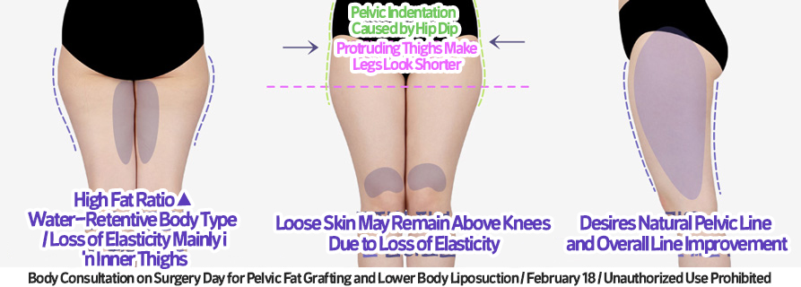 thigh_liposuction_02_04_231215