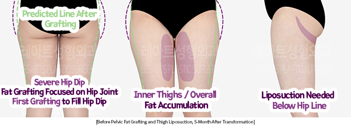 thigh_liposuction_02_05