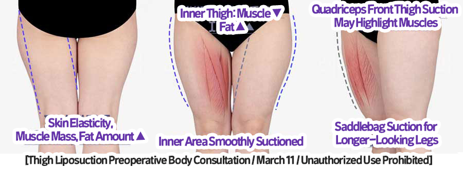 thigh_liposuction_02_05