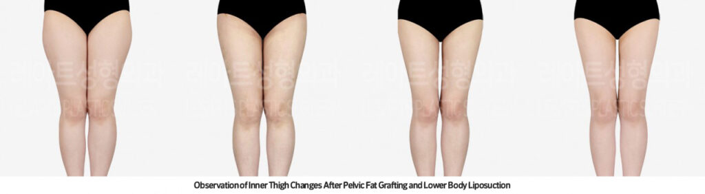 thigh_liposuction_02_05_231215
