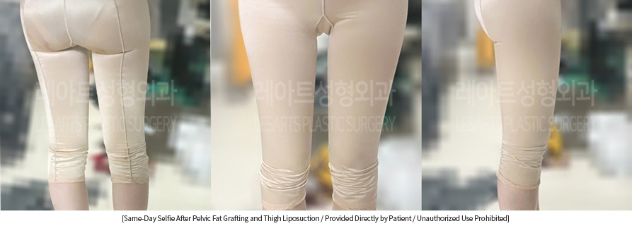 thigh_liposuction_02_06