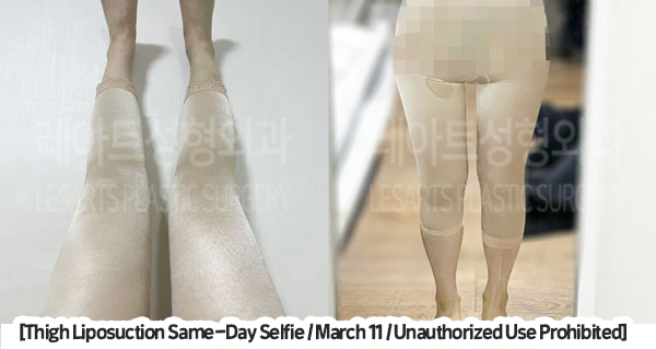 thigh_liposuction_02_06