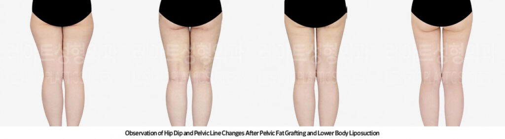 thigh_liposuction_02_06_231215