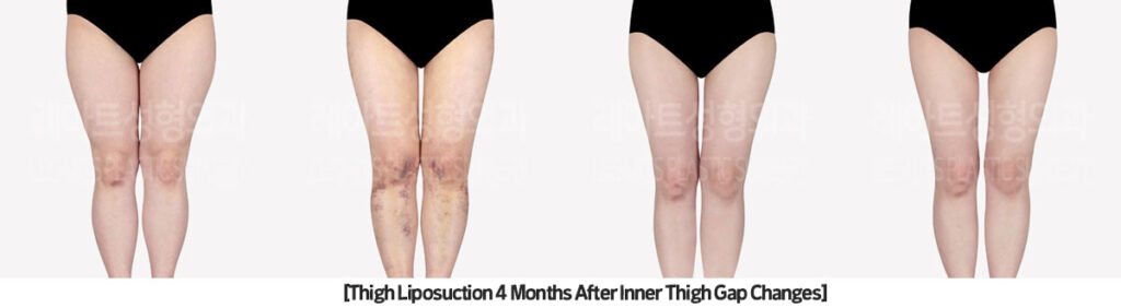 thigh_liposuction_02_07