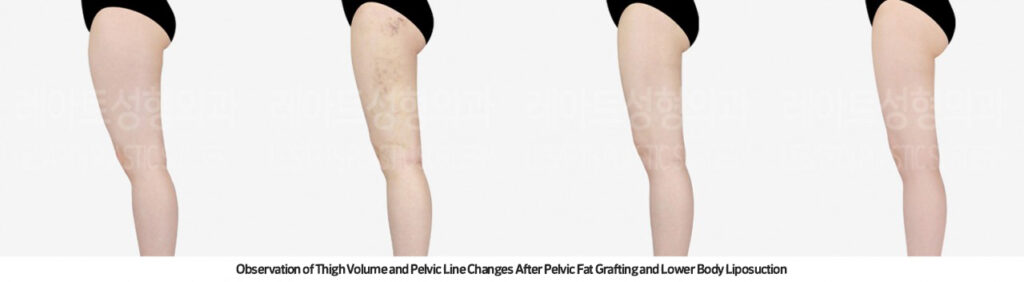 thigh_liposuction_02_07_231215