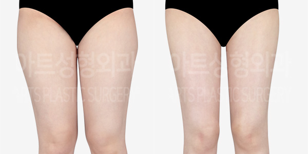 thigh_liposuction_02_08