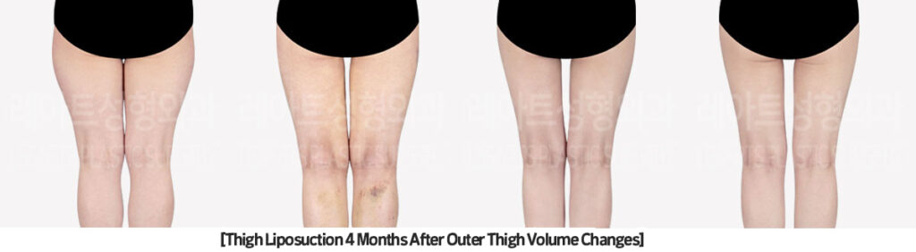 thigh_liposuction_02_08