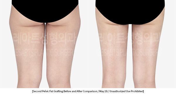 thigh_liposuction_02_09