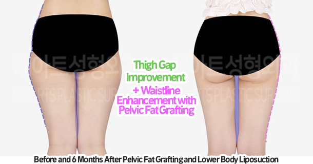 thigh_liposuction_02_09_231215