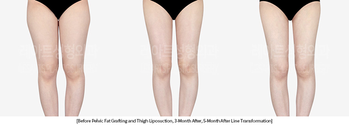 thigh_liposuction_02_10