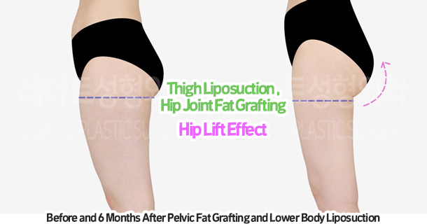 thigh_liposuction_02_10_231215