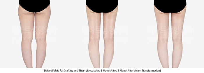 thigh_liposuction_02_11