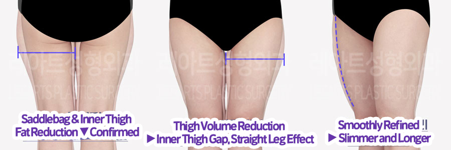 thigh_liposuction_02_11