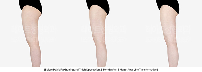 thigh_liposuction_02_12