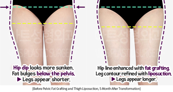 thigh_liposuction_02_13