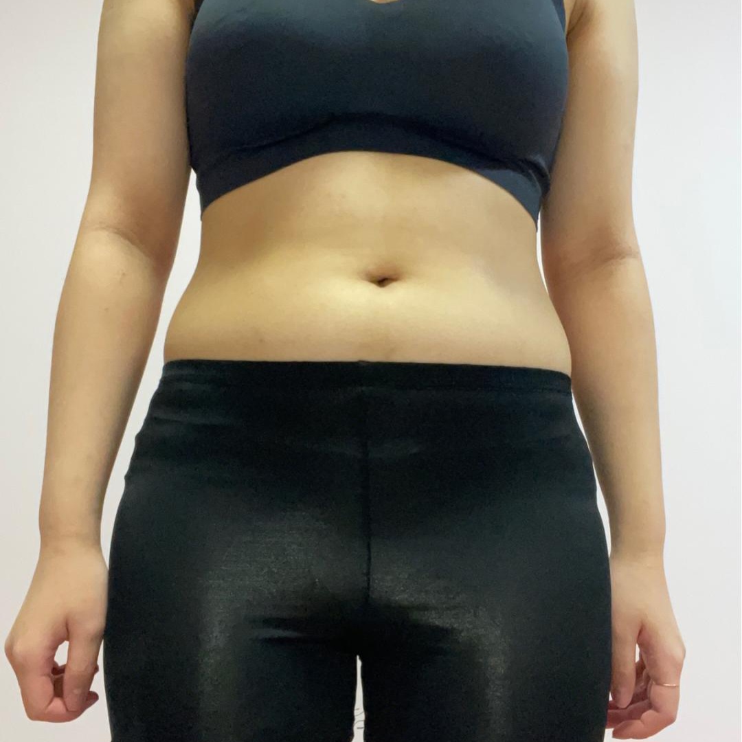 abdominal-liposuction-before-qsxvfr
