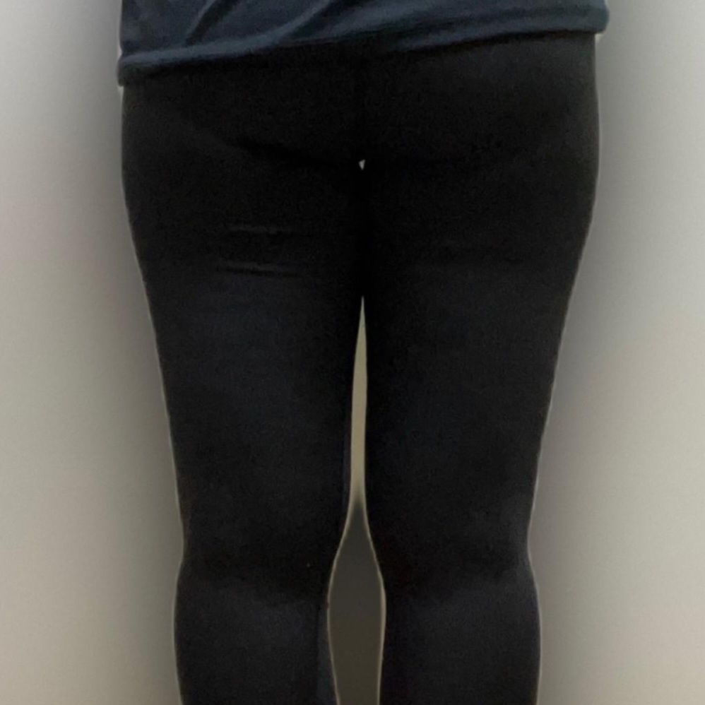 thigh-liposuction-before-selfie