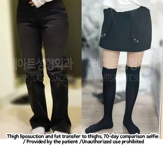 Liposuction-Revision-thigh-iposuction-thigh-Fat-Transfer-02-01-240208
