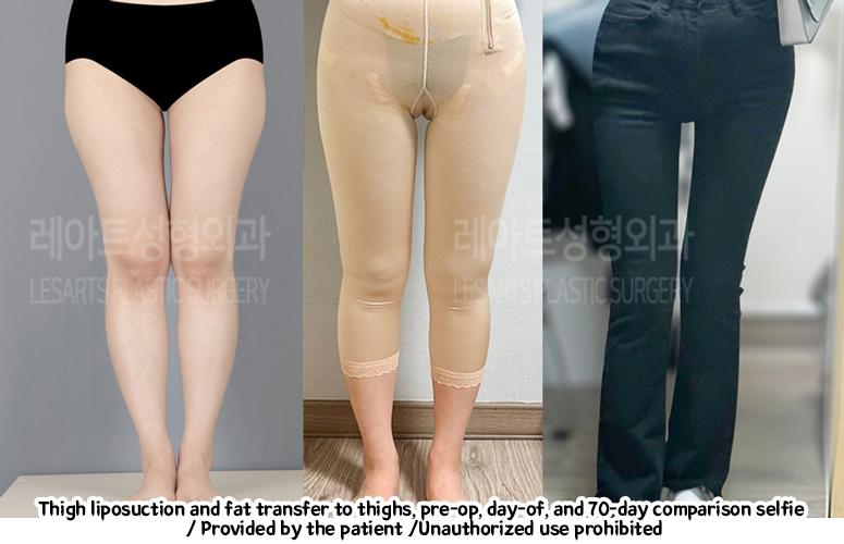 Liposuction-Revision-thigh-iposuction-thigh-Fat-Transfer-02-02-240208