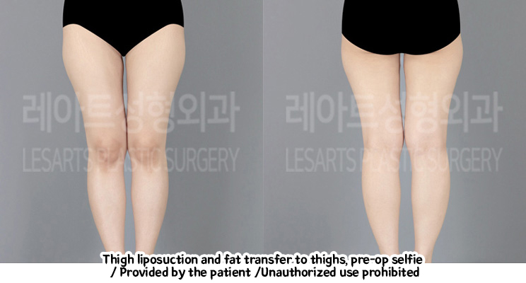 Liposuction-Revision-thigh-iposuction-thigh-Fat-Transfer-02-03-240208