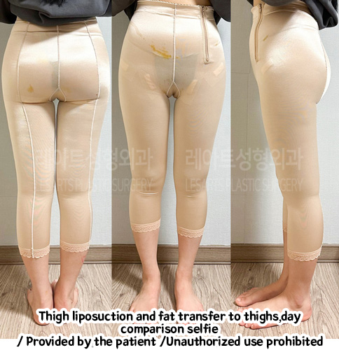 Liposuction-Revision-thigh-iposuction-thigh-Fat-Transfer-02-05-240208