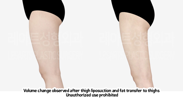 Liposuction-Revision-thigh-iposuction-thigh-Fat-Transfer-02-08-240208