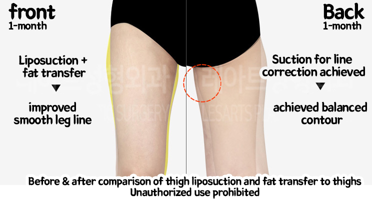 Liposuction-Revision-thigh-iposuction-thigh-Fat-Transfer-02-09-240208