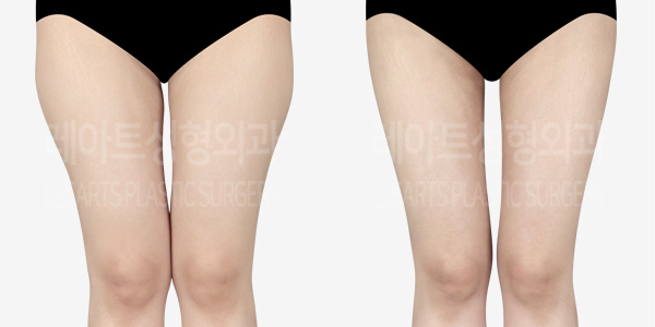 Liposuction Revision thigh iposuction thigh Fat Transfer-thumbnail-01-240208