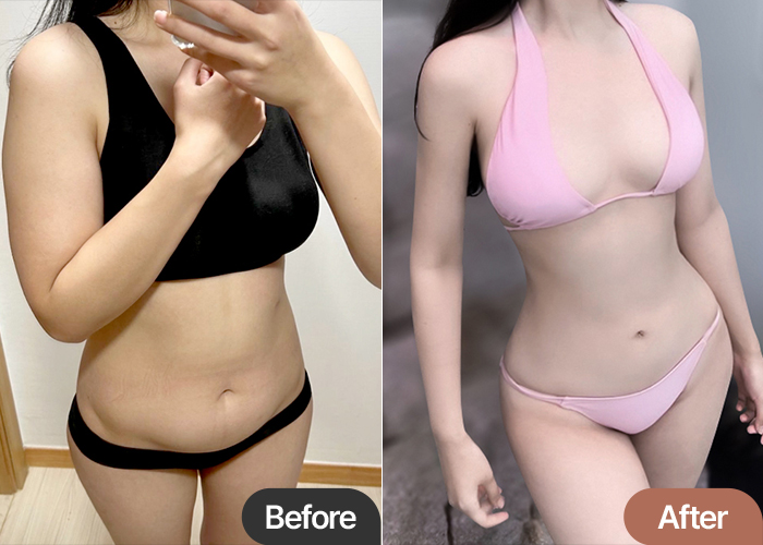 abdominal-liposuction-thumbnail-Gangnamnunnu