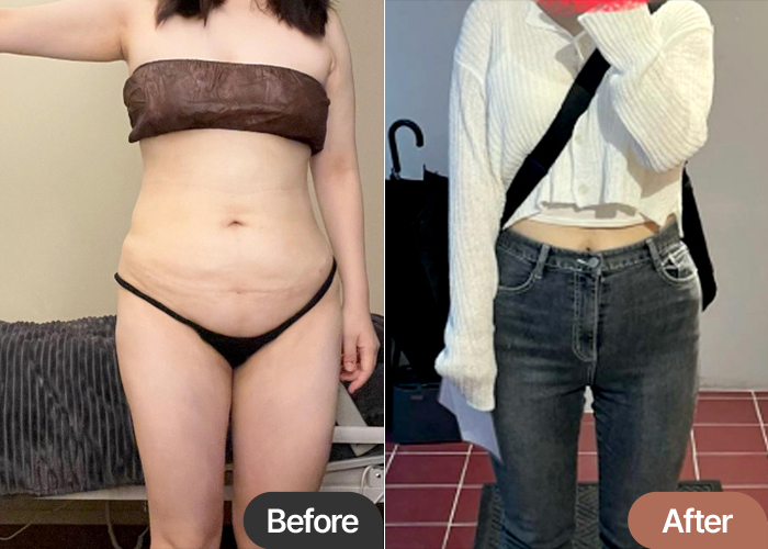 abdominal-liposuction-thumbnail-selfie-Bombambbang