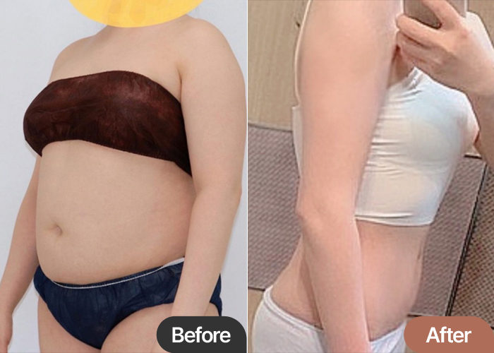 abdominal-liposuction-thumbnail-selfie-Dujumeok