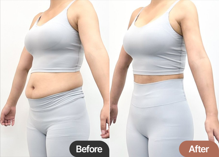 abdominal-liposuction-thumbnail-selfie-Jennie