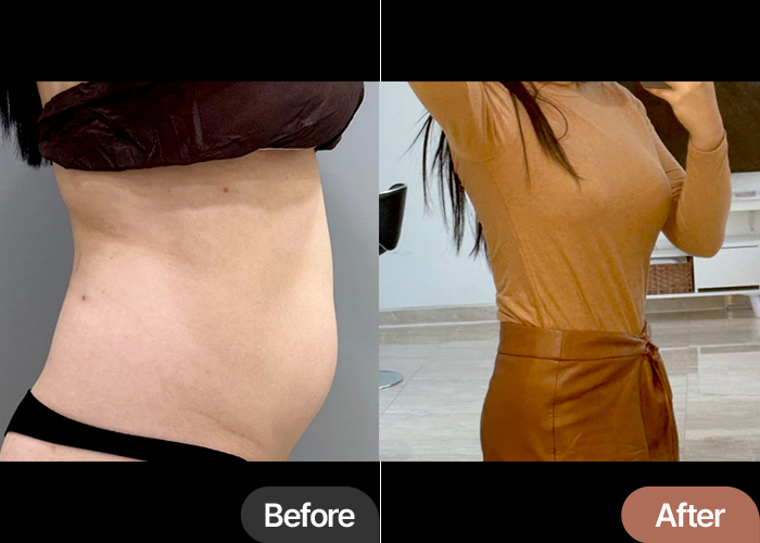 abdominal-liposuction-thumbnail-selfie-Nanananahi