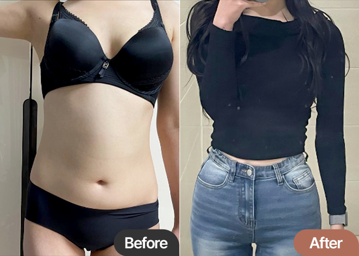 abdominal-liposuction-thumbnail-selfie-Oreo