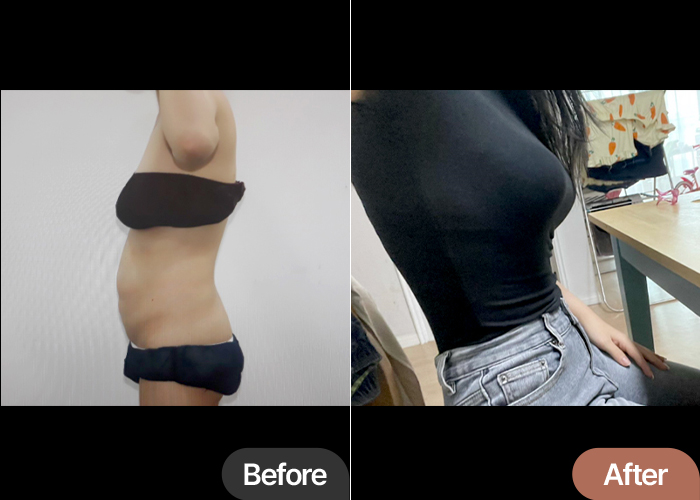 abdominal-liposuction-thumbnail-selfie-Siayum