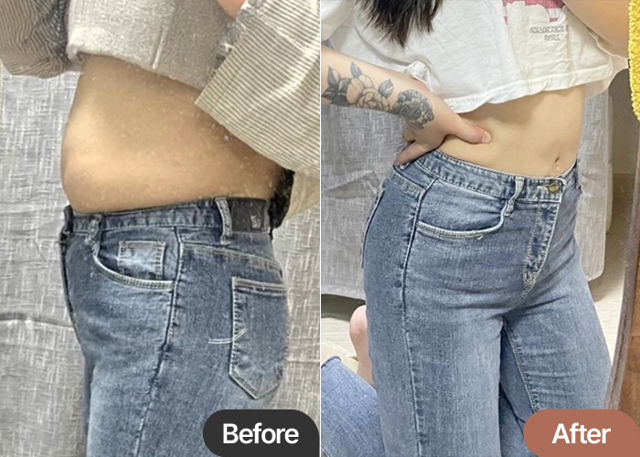abdominal-liposuction-thumbnail-selfie-cvvff