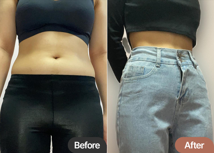 abdominal-liposuction-thumbnail-selfie-qsxvf
