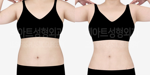 abdominal_liposuction_01_thumbnail_230227