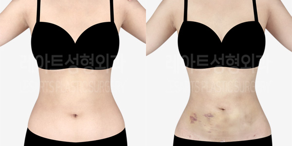 abdominal_liposuction_01_thumbnail_230306