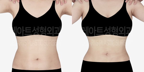 abdominal_liposuction_01_thumbnail_230307