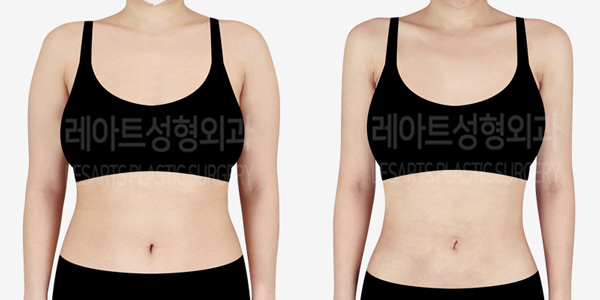 arm_liposuction-abdominal_01_thumbnail_231225
