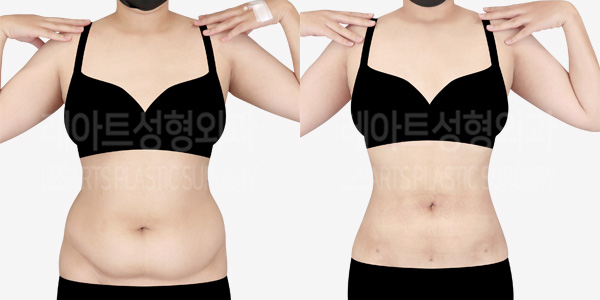 abdominal_liposuction_01_thumbnail_240105