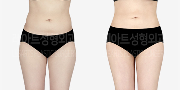 abdominal_liposuction_01_thumbnail_240119