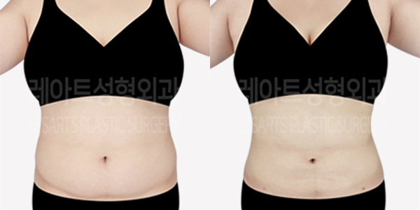abdominal_liposuction_01_thumbnail_240529