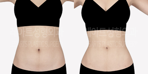 abdominal_liposuction_01_thumbnail_240604
