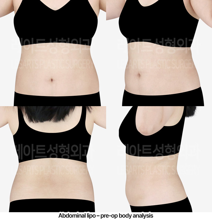 abdominal_liposuction_02_01_230227