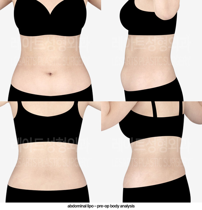 abdominal_liposuction_02_01_230306