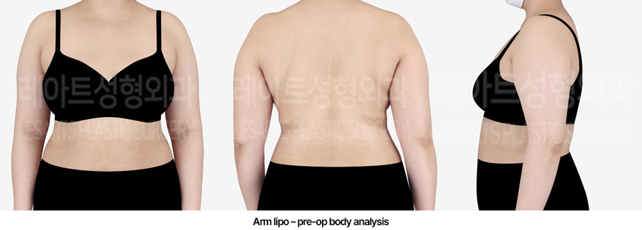 abdominal_liposuction_02_01_2303072