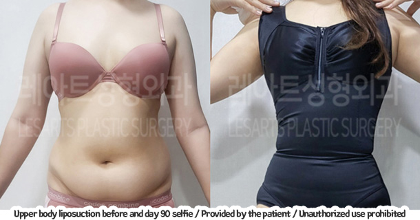 abdominal_liposuction_02_01_240105