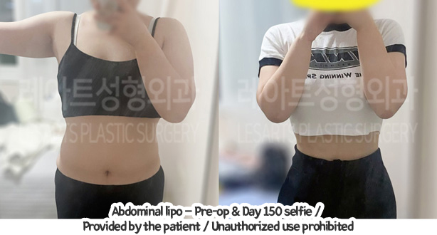 abdominal_liposuction_02_01_240110
